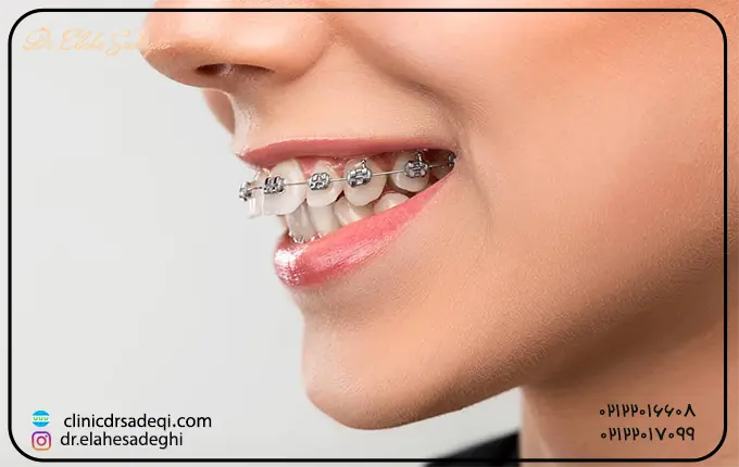 انواع مختلف برآمدگی دندان جلویی بالا یا اورجت