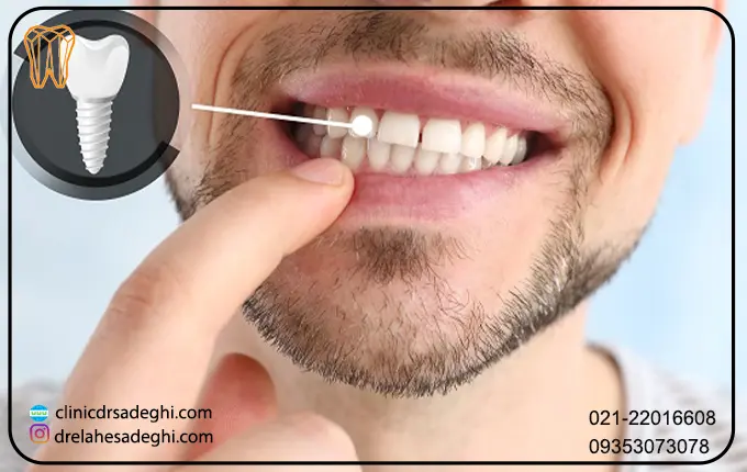 آیا ایمپلنت دندان دائمی است؟