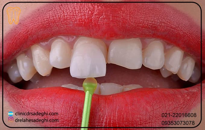 6 برند برتر لمینت دندان